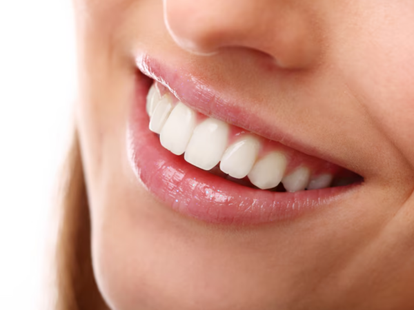 Lente de contato dental: o segredo de um sorriso perfeito