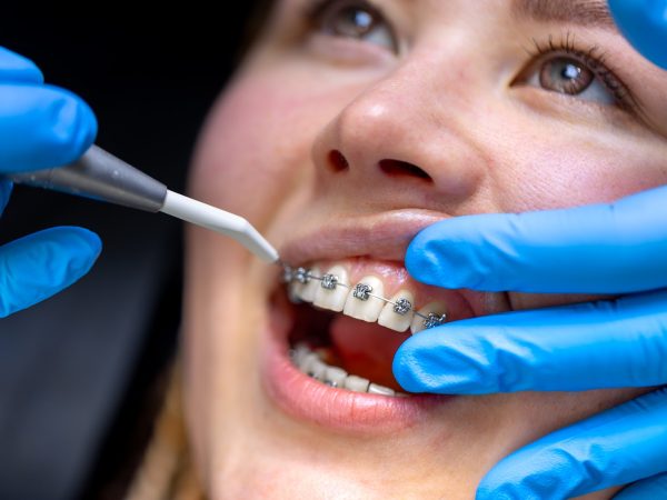 Por que o aparelho ortodôntico ainda é a melhor opção para alinhamento dos dentes?